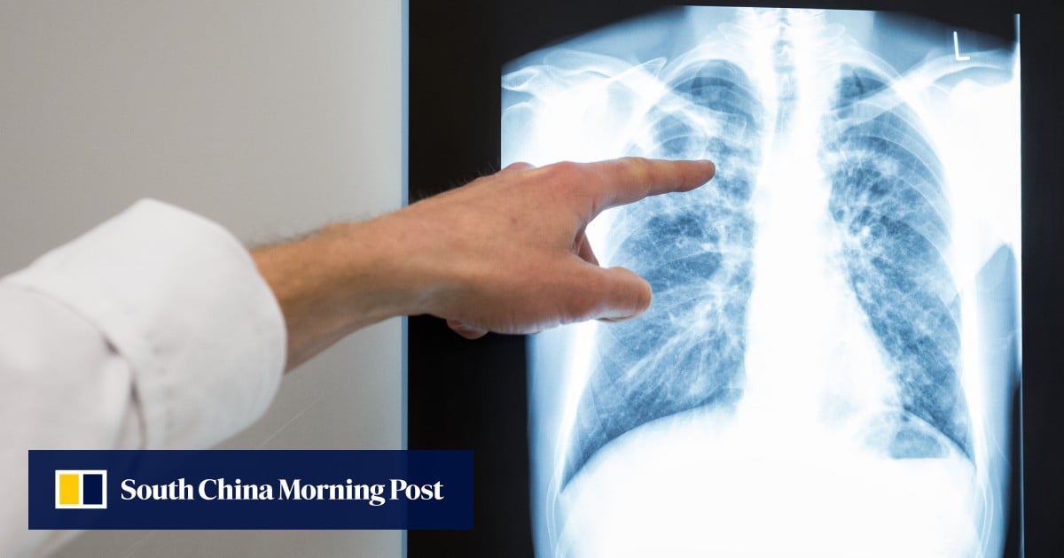 Malaysia’s tuberculosis cases rise to above 3,000, health ministry flags risks