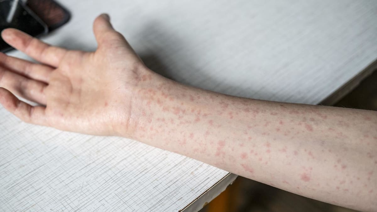 Singapore detects 12 more measles cases, including 4 in a cluster