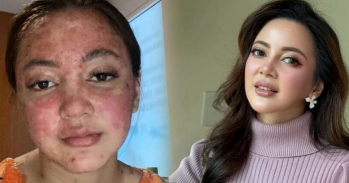 #SHOWBIZ: Actress Sharmaine Alexander explains swollen face due to psoriasis medication